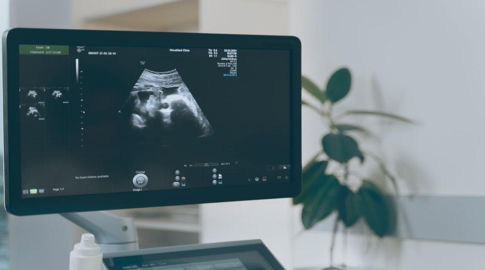Ultrasound monitor showing a fetus